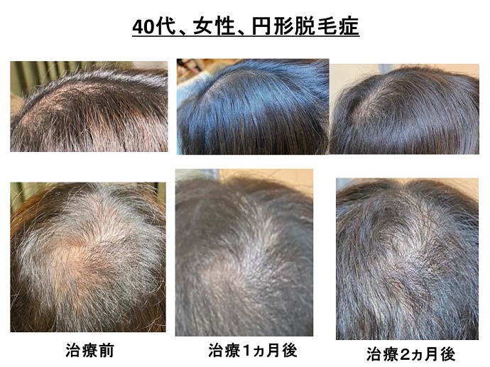 汎発性脱毛　病院
